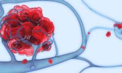 Борьба с метастазами