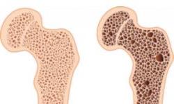 Эффективное лечение остеопороза